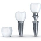 Proteza całkowita na implantach Poznań – komfort nowej generacji