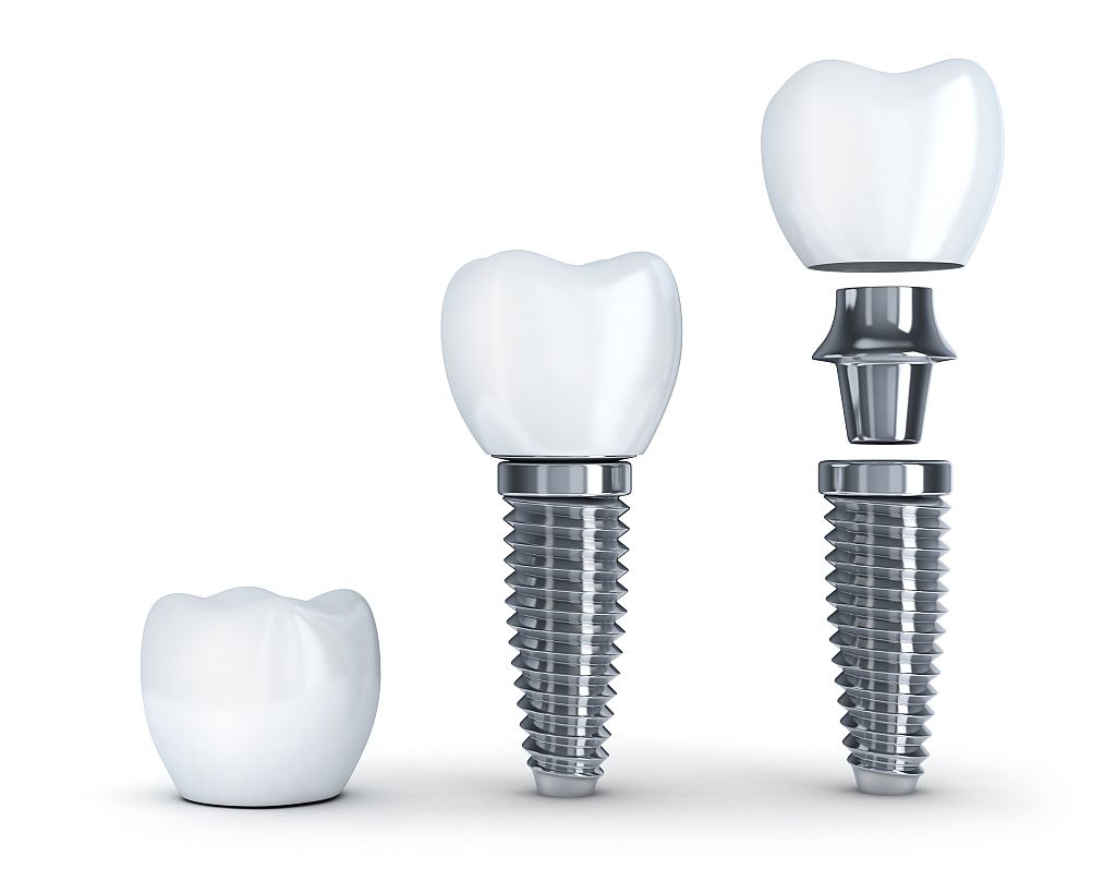 Proteza całkowita na implantach Poznań – komfort nowej generacji