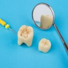 Dlaczego ząb leczony kanałowo może się złamać? I jak tego uniknąć