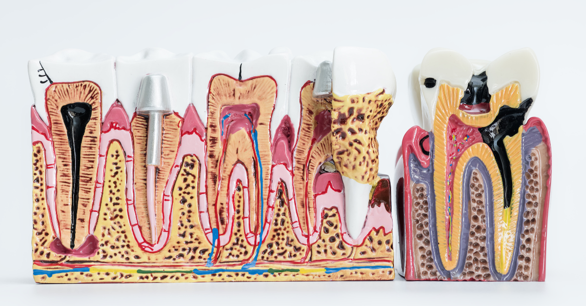 Endodoncja (leczenie kanałowe) w&nbsp;Praktyka Dentystyczna – skuteczne ratowanie zębów w&nbsp;Poznaniu