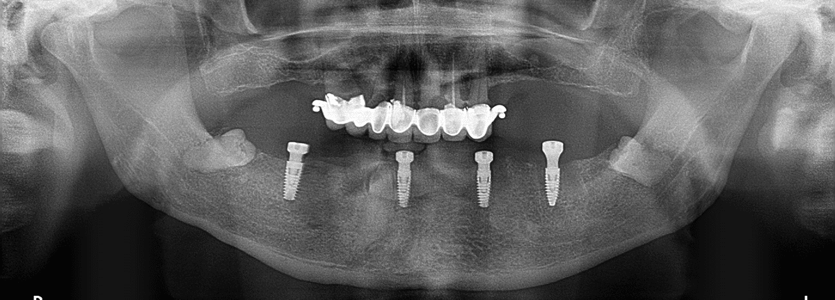Implanty zębowe w&nbsp;Poznaniu – trwała odbudowa uśmiechu i&nbsp;komfortu życia